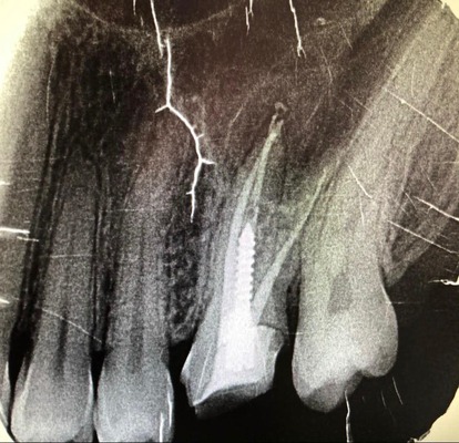 tooth extraction abu dhabi